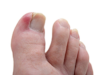 Damaged and Isolated Septic Ingrown Toenail